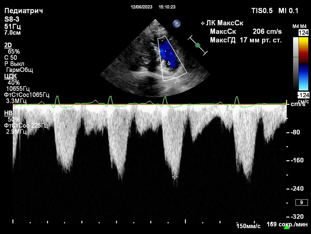 Оценка систолической функции при выявленном шуме