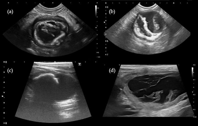 Выявление цистита без камней