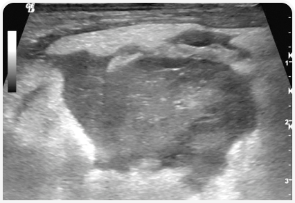 Диагностика панкреатита