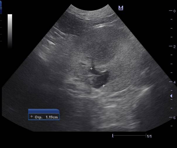 Ранняя диагностика нефропатии
