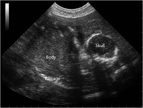 Оценка сроков родов