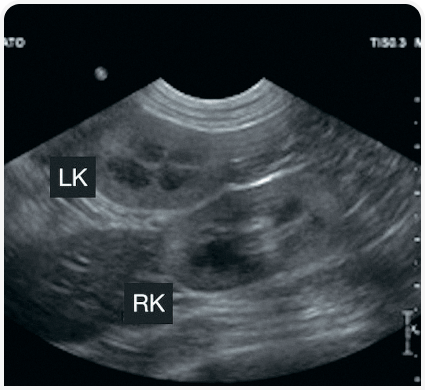 Ранняя диагностика хронической болезни почек
